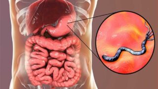 علاج فعال لجرثومة المعدة: الخيارات المتاحة والتوصيات الهامة