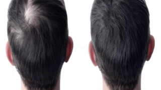 زراعة الشعر حلاً فعالًا لتساقط الشعر والصلع