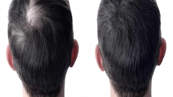 زراعة الشعر حلاً فعالًا لتساقط الشعر والصلع