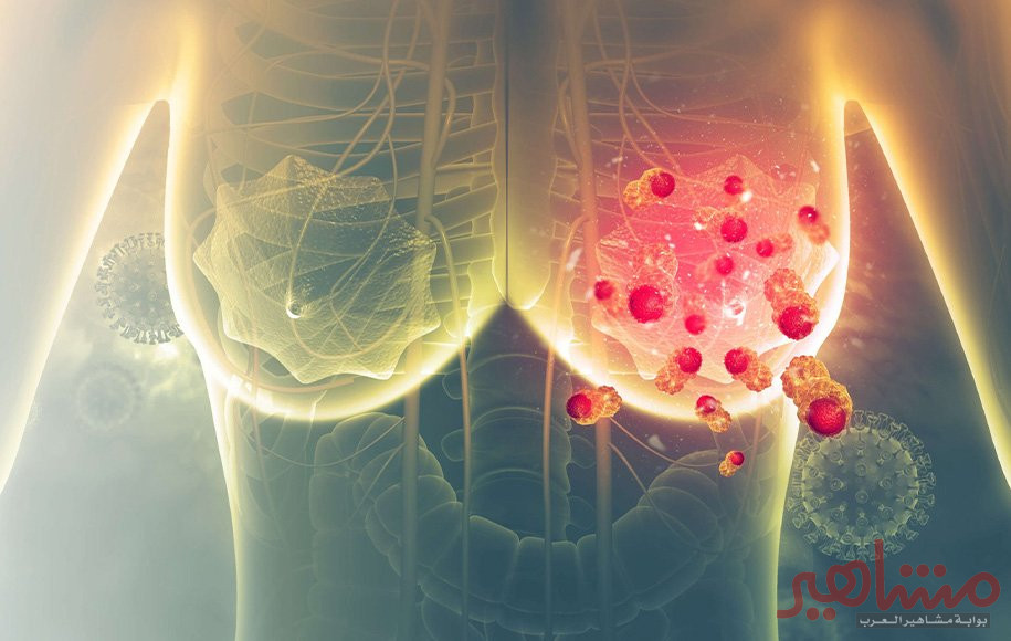 سرطان الثدي