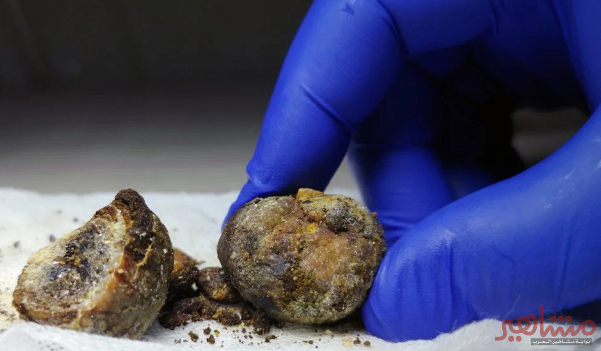 حصوات المرارة ونقاط مهمة يجب أن تعرفها