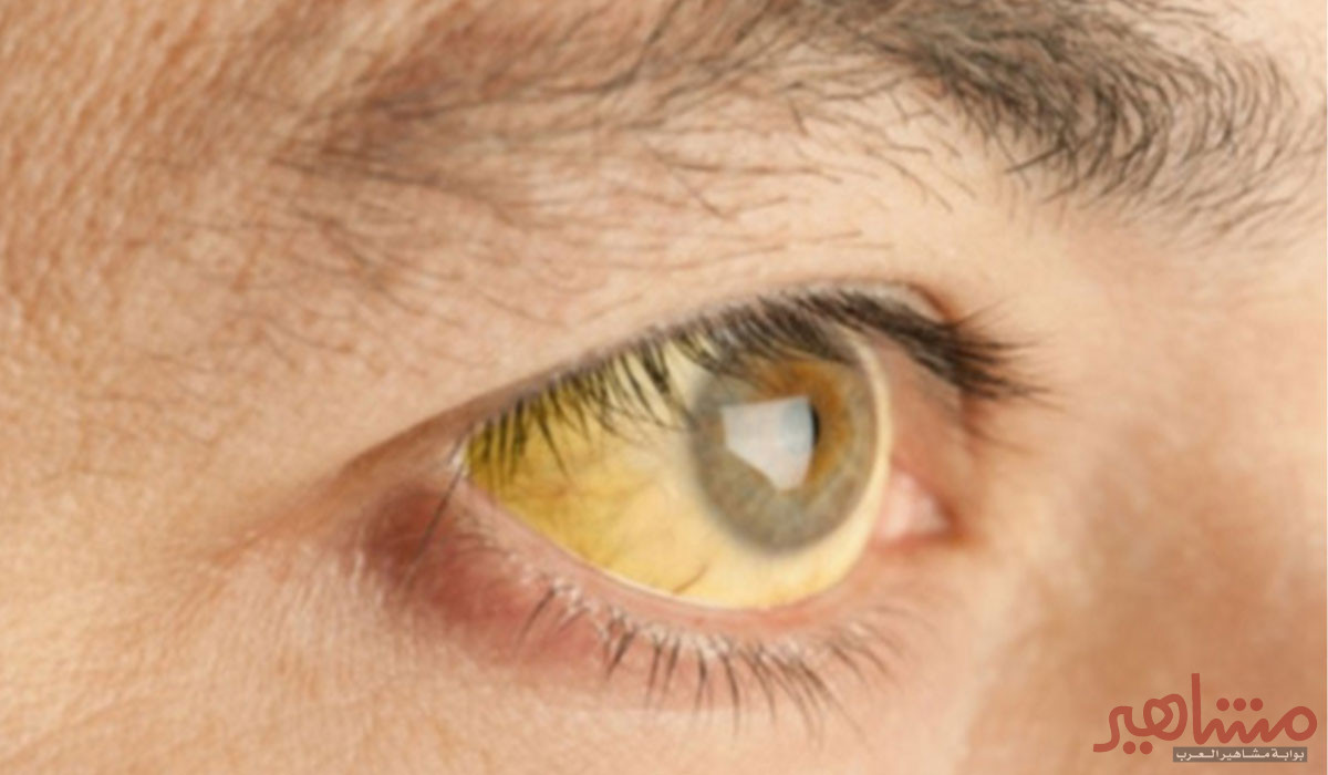 حصوات المرارة ونقاط مهمة يجب أن تعرفها