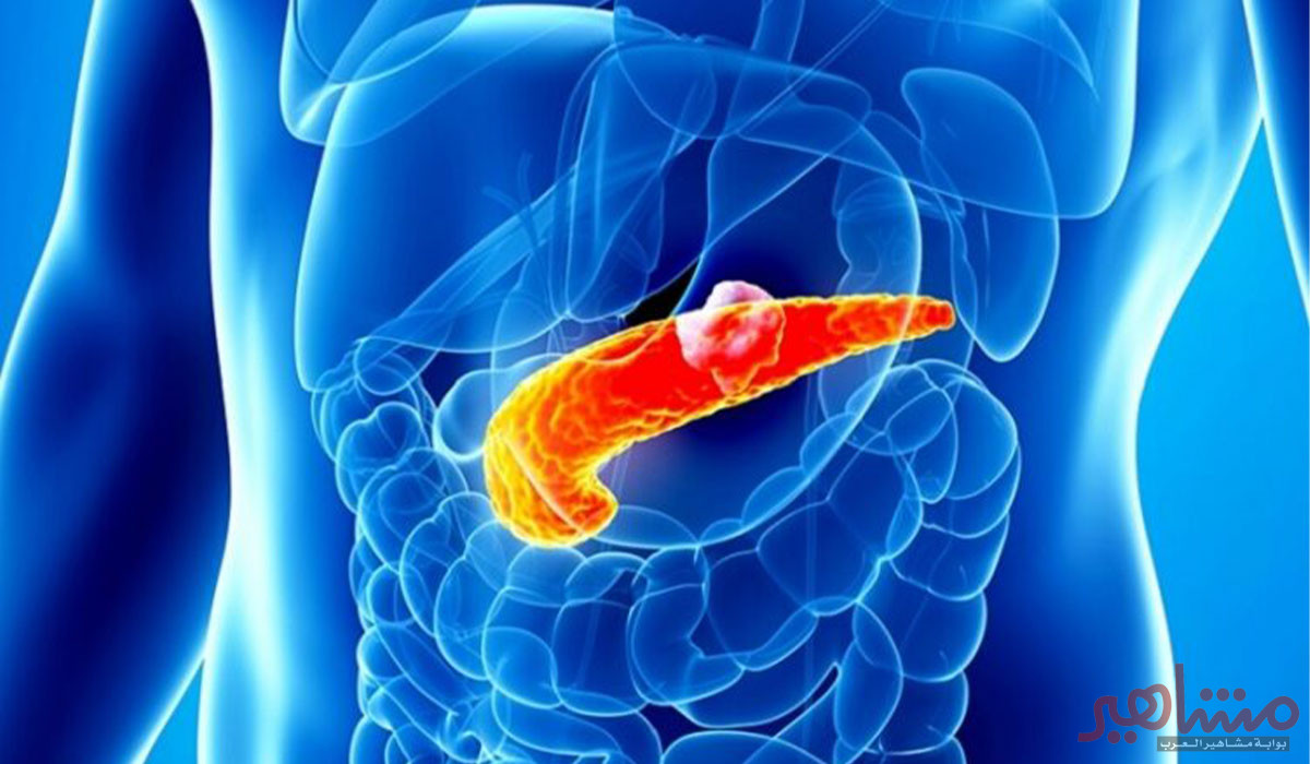 حصوات المرارة ونقاط مهمة يجب أن تعرفها